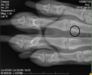 Enlarged view of fractured bone